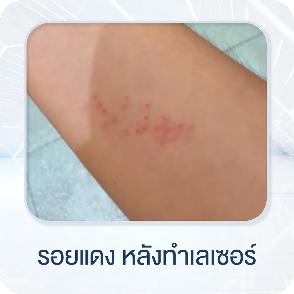 รอยแดง หลังทำเลเซอร์