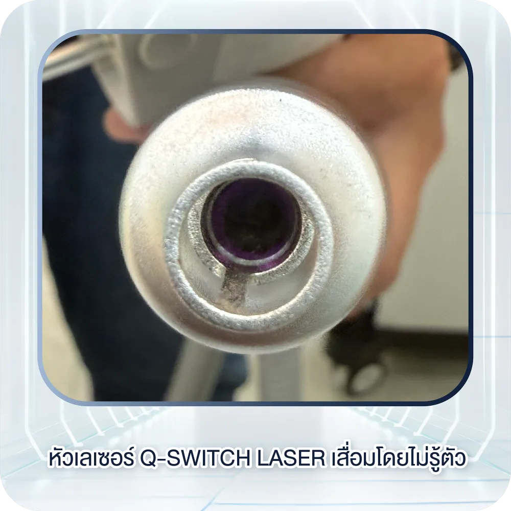 หัวเลเซอร์ Q-Switch Laser เสื่อมโดยไม่รู้ตัว